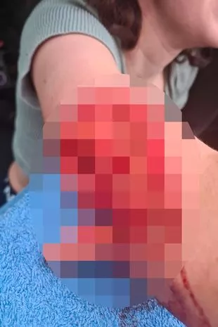 当爸爸和狗狗摔跤时,它咬伤了12岁女孩的手臂,XL Bully的主人“毫不在意”